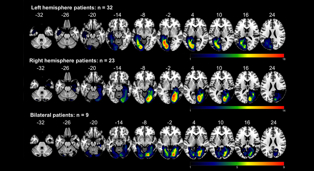 Brain scan - left hemisphere patients